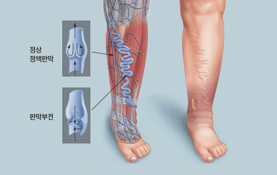 만성정맥부전증